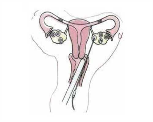 三代试管供卵在哪可以做,做试管婴儿会导致乳腺