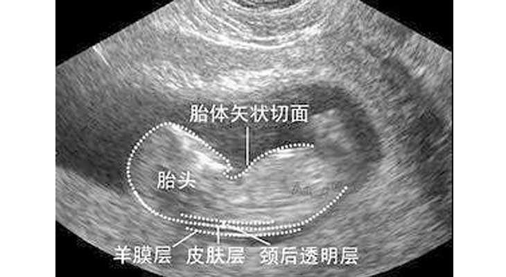 国外产子的费用_NT检查大揭秘！新竹市做三代试管婴儿孕期还要查NT吗？